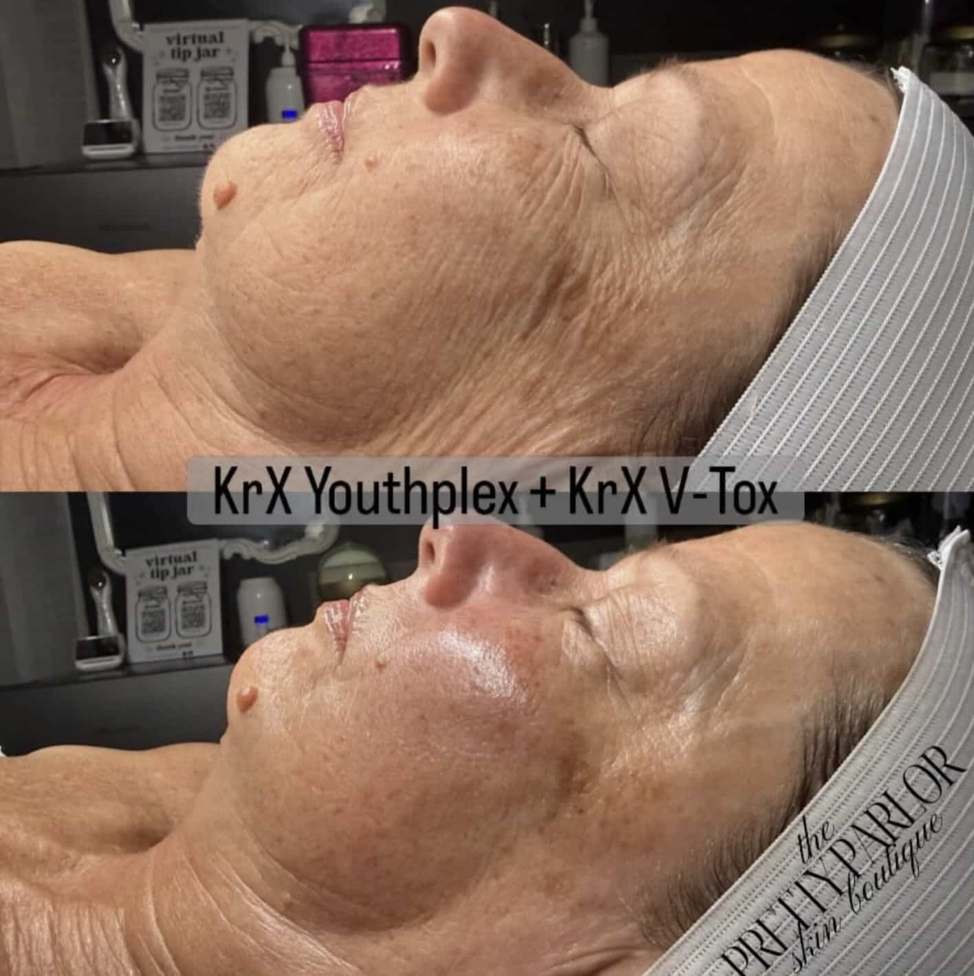 A side-by-side comparison of a woman's face before and after a skincare treatment. The top image shows her with visible wrinkles and blemishes, while the bottom image displays smoother skin with a more even tone. Both images are labeled with the names of the treatments used.