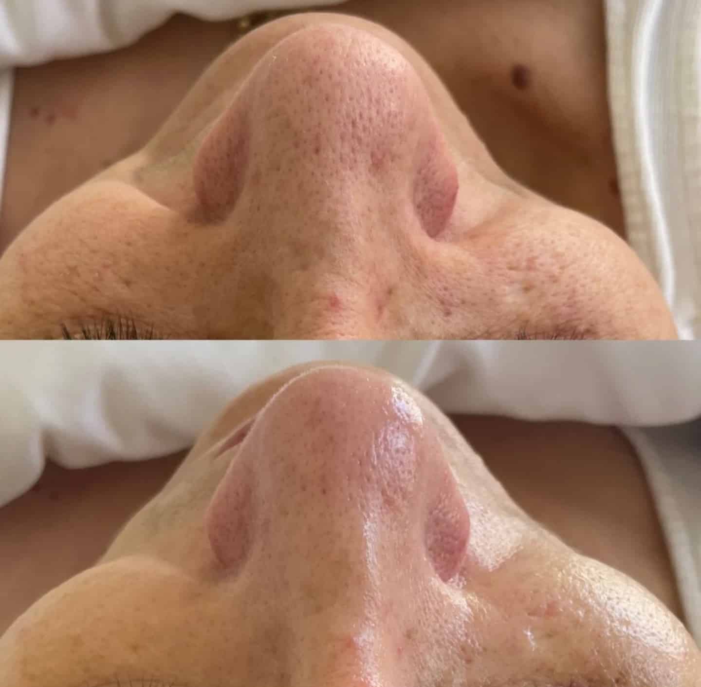 A close-up image showing two views of a person's nose. The top image displays a nose with visible pores and blemishes, while the bottom image presents a smoother nose with reduced imperfections. The background is neutral and subtle.