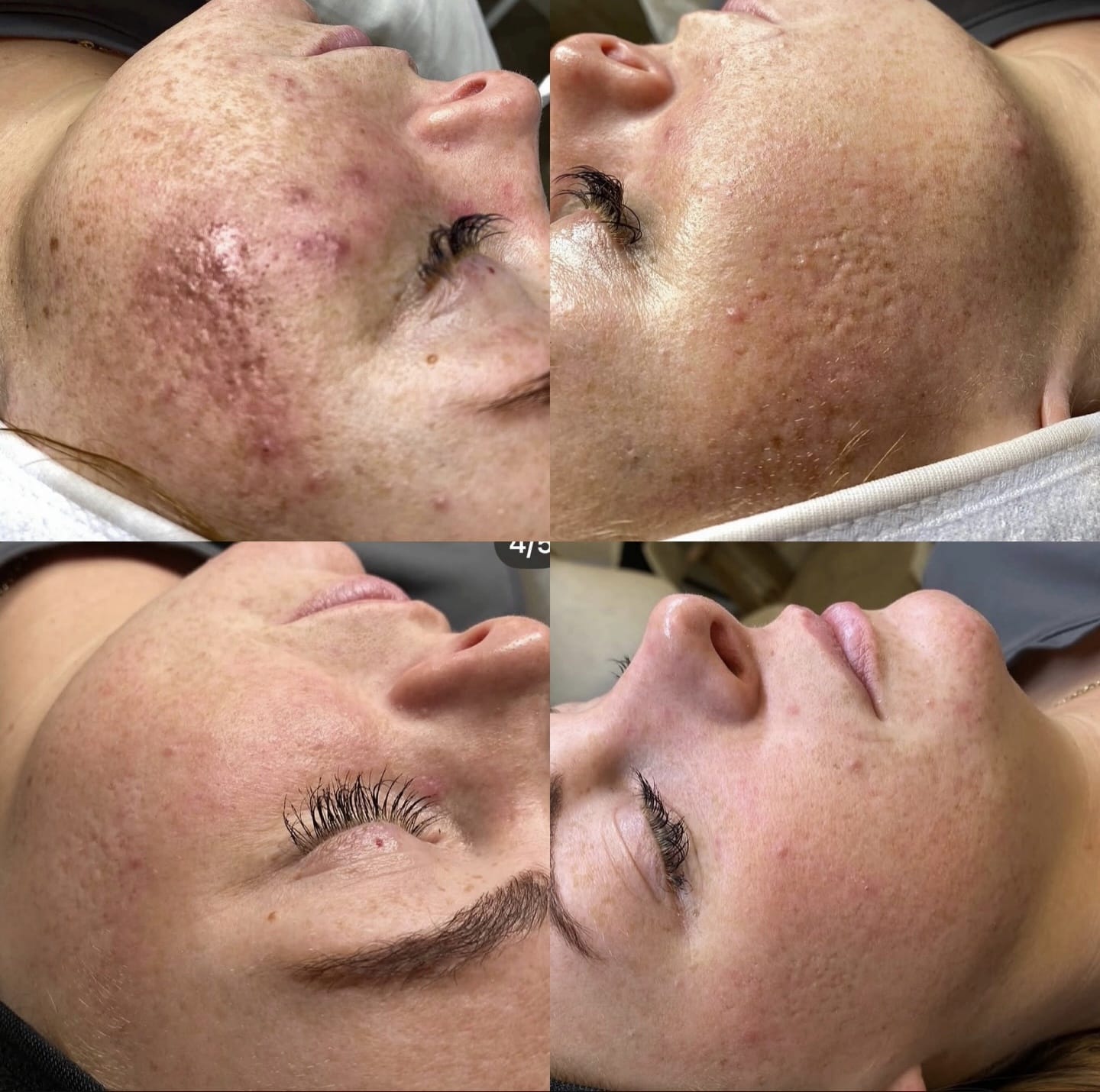 A close-up of a woman's face shown in four sections. The top left features skin with acne scars, while the top right shows smoother skin. The bottom left has longer eyelashes, and the bottom right displays a similar skin tone with minimal blemishes.