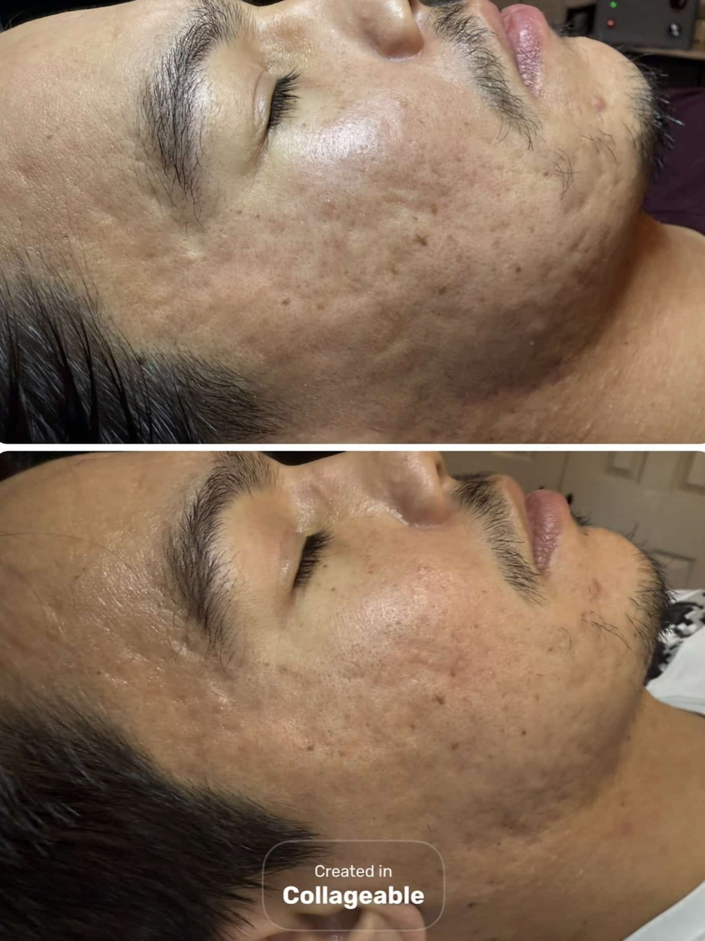 A side profile of a man showing two stages of skin texture. The top image illustrates uneven skin with visible acne scars, while the bottom shows smoother skin with reduced imperfections.