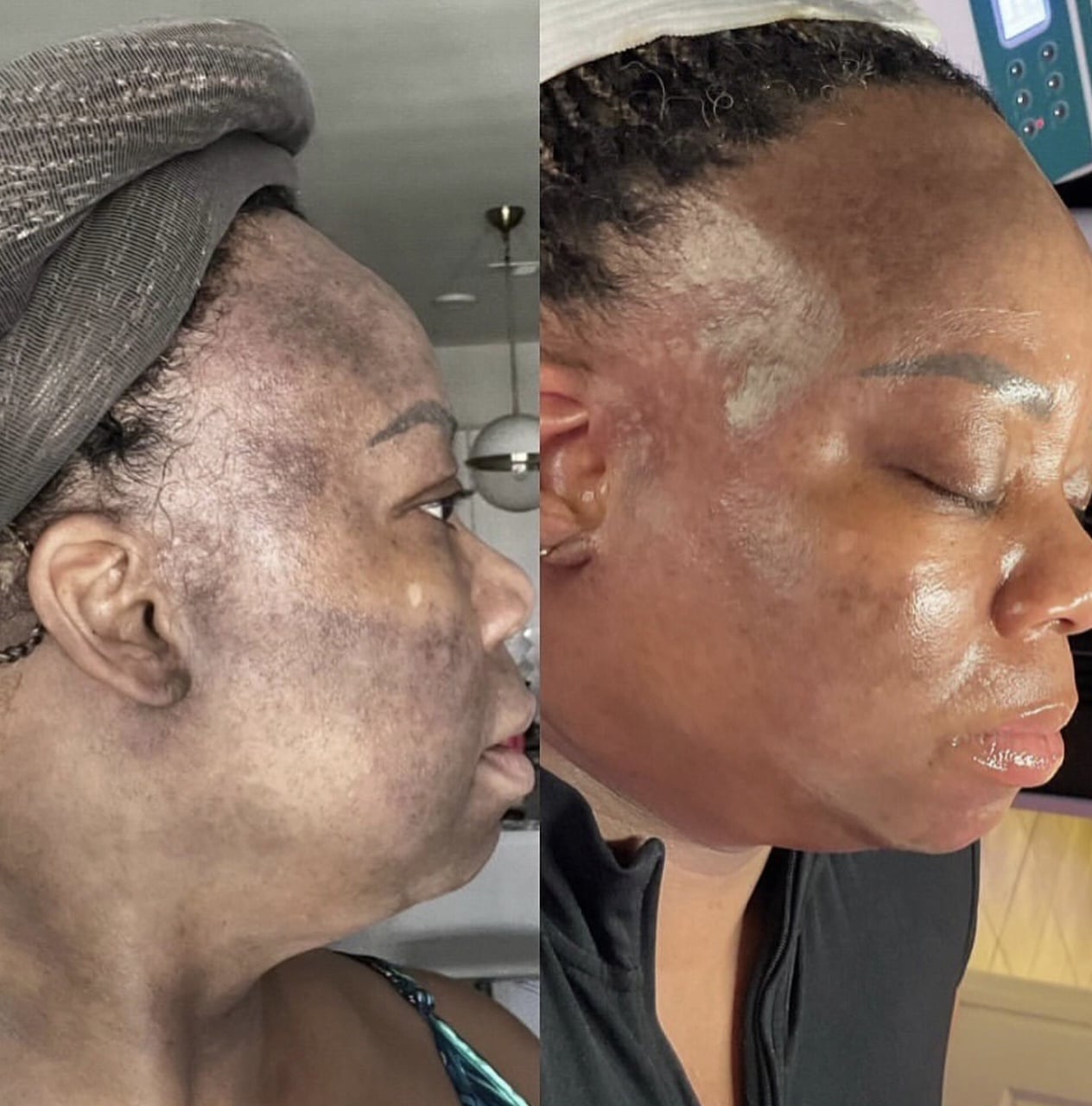 A side-by-side comparison of a woman's face showing changes in skin condition. The left image displays dark patches and texture on her cheek, while the right image shows a smoother complexion with less discoloration.