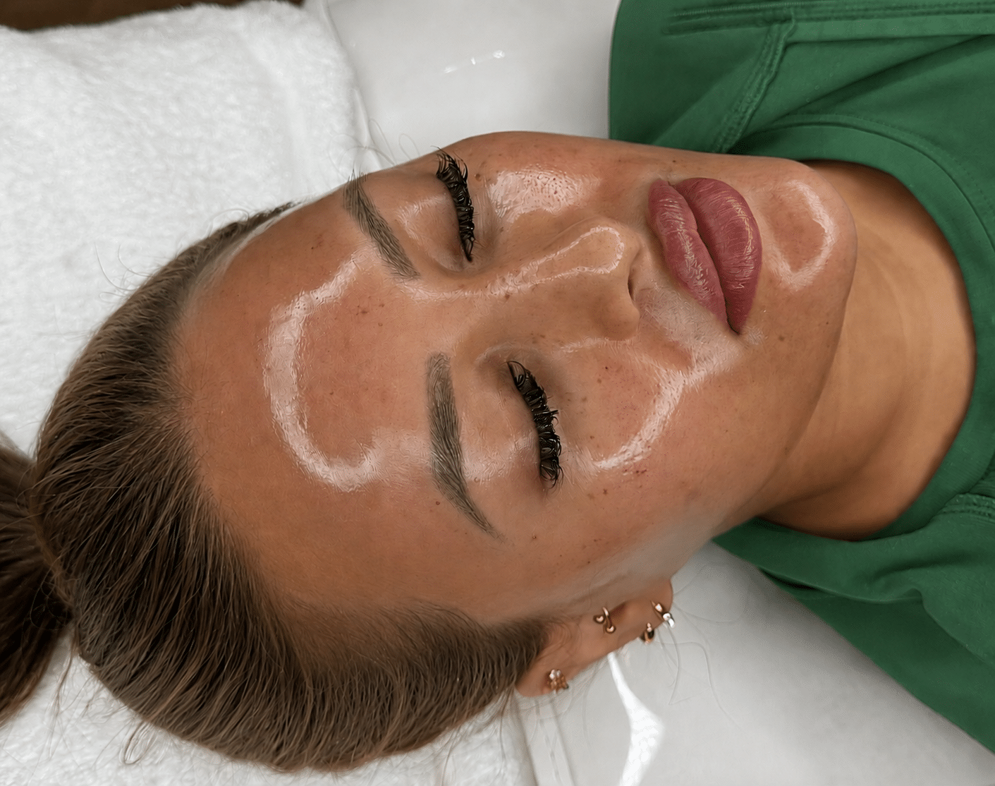 A woman lies on a treatment table with her eyes closed. Her face has a clear gel applied in specific areas for a skin treatment. She has long eyelashes, and her hair is tied back. The background includes a white towel and a green top.