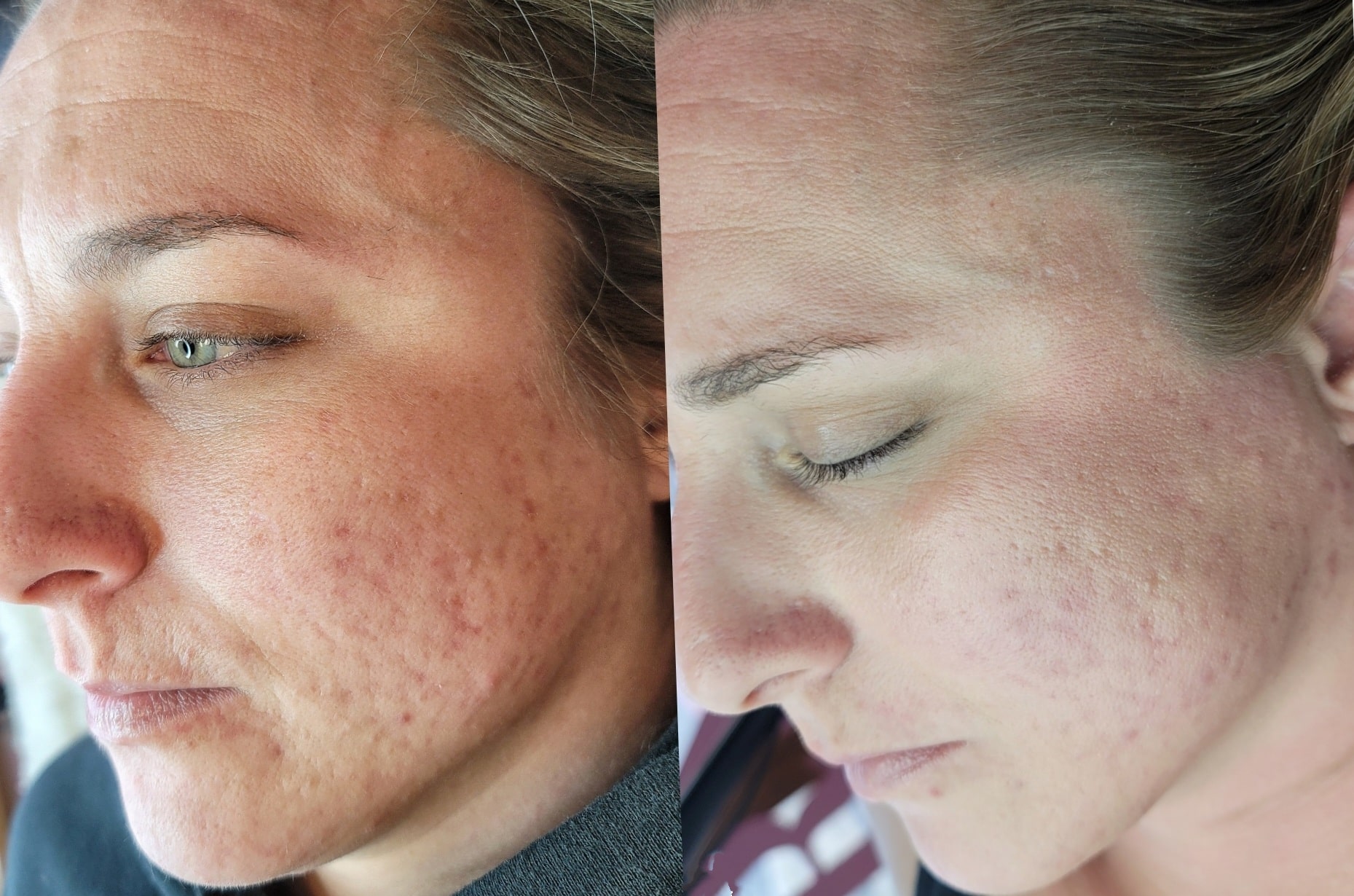 A side-by-side close-up of a woman’s face showing visible skin blemishes on one side and clearer skin on the other, with her hair pulled back.