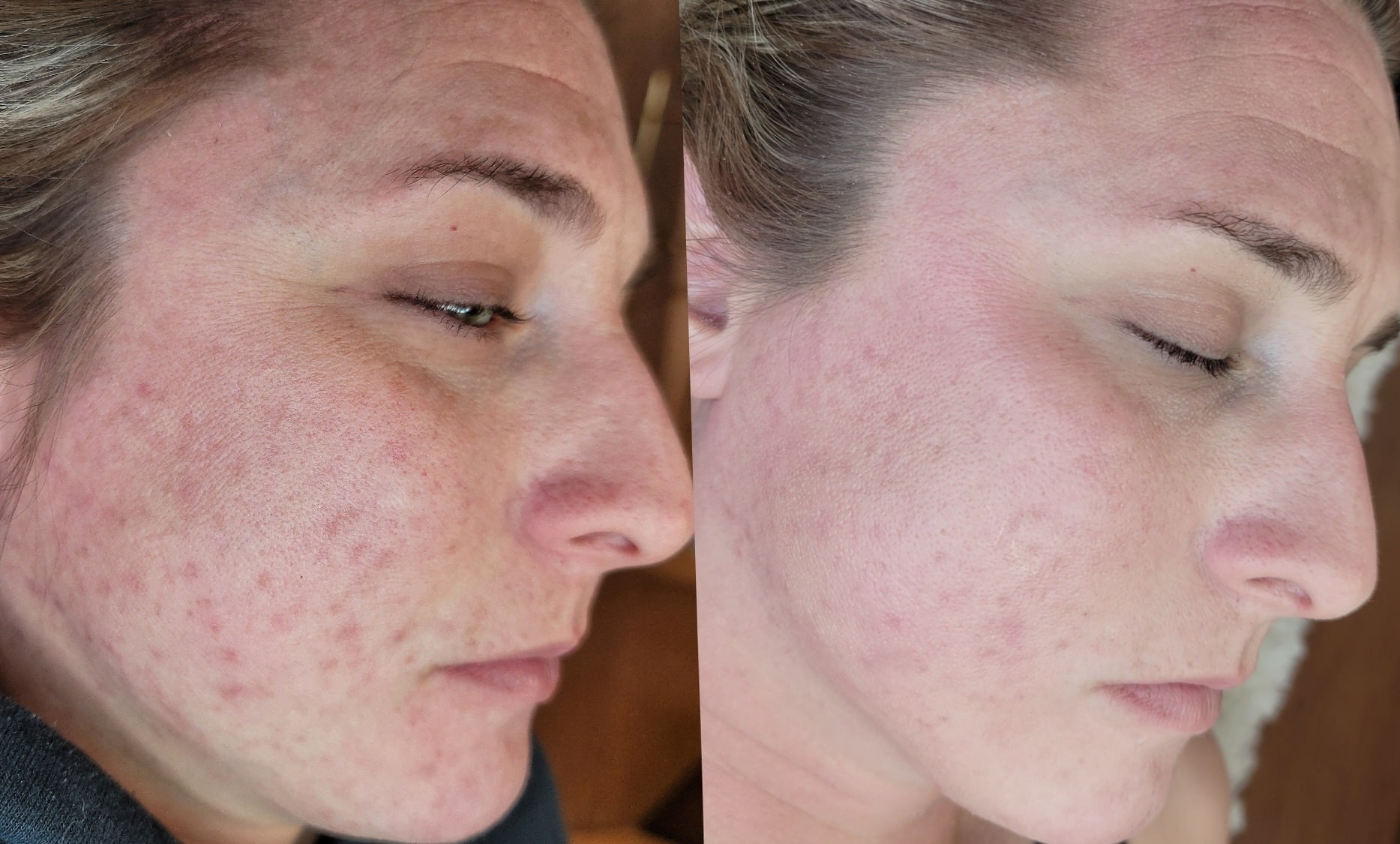 Side-by-side close-up profile photos of a woman's face showing acne-prone skin on the left and smoother skin on the right.
