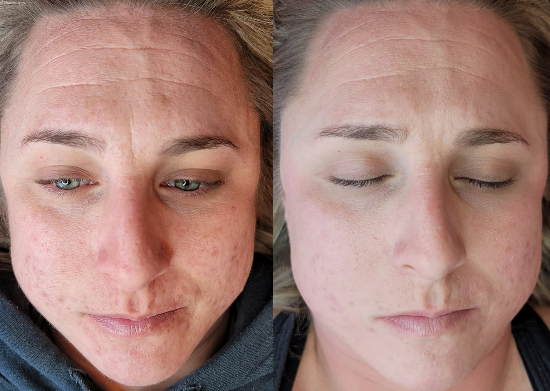 A close-up split image shows a woman's face before and after a skincare treatment, with visible redness and blemishes on the left and smoother skin with closed eyes on the right.