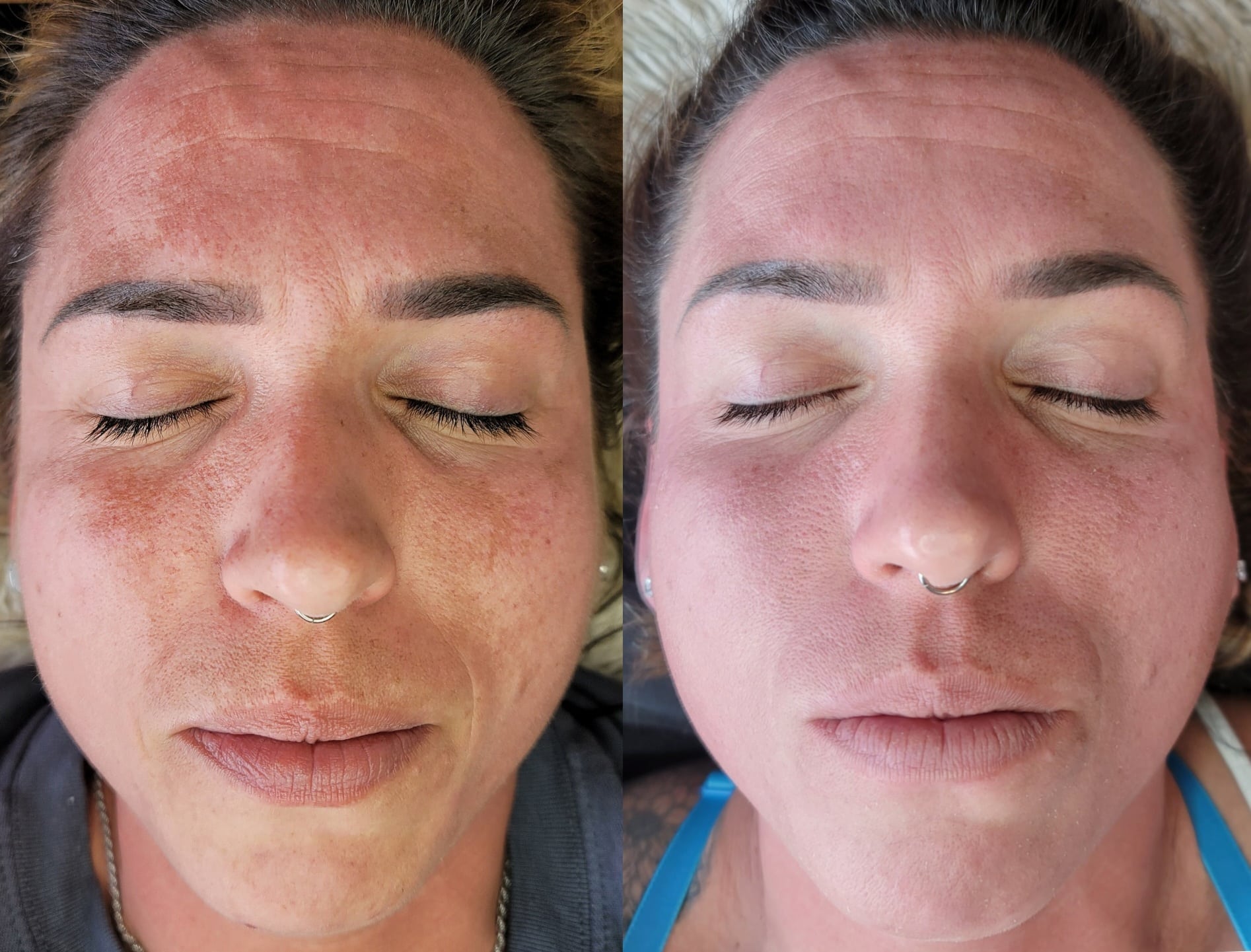 A split-screen close-up of a woman with closed eyes and a nose ring, showing a freckled face on the left and a smoother complexion on the right.
