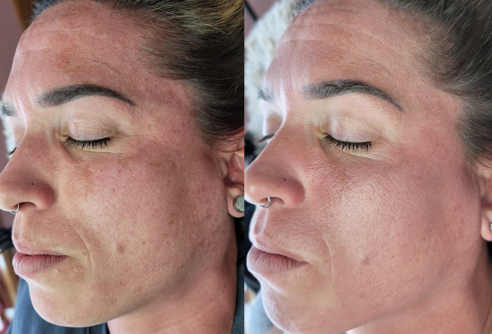 Side-by-side close-up profile photos of a woman with closed eyes, showing uneven skin on the left image and smoother skin on the right.