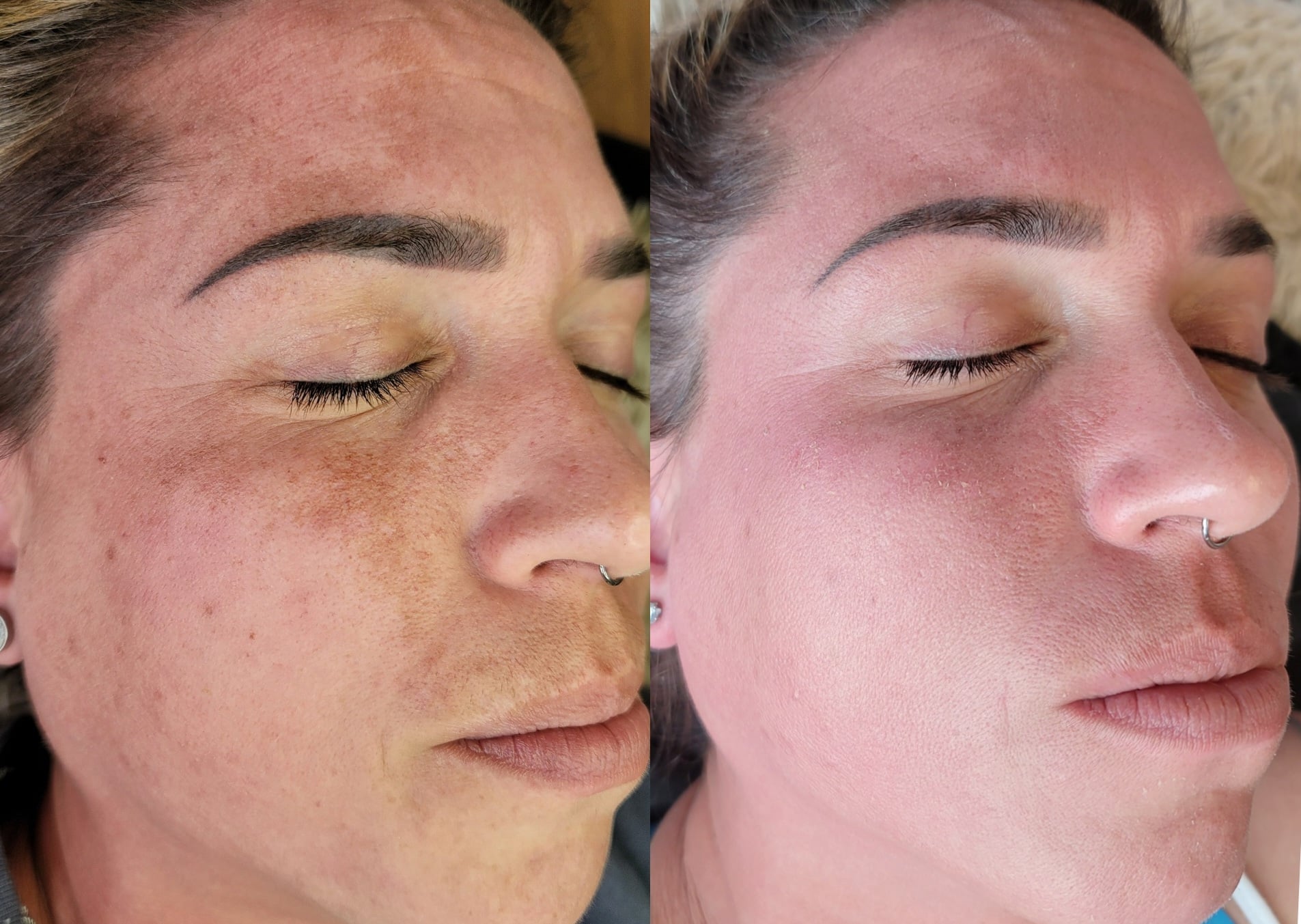 A split-screen close-up shows the same woman's face before and after skincare treatment, with darker freckles and redness on the left and smoother, lighter skin on the right.