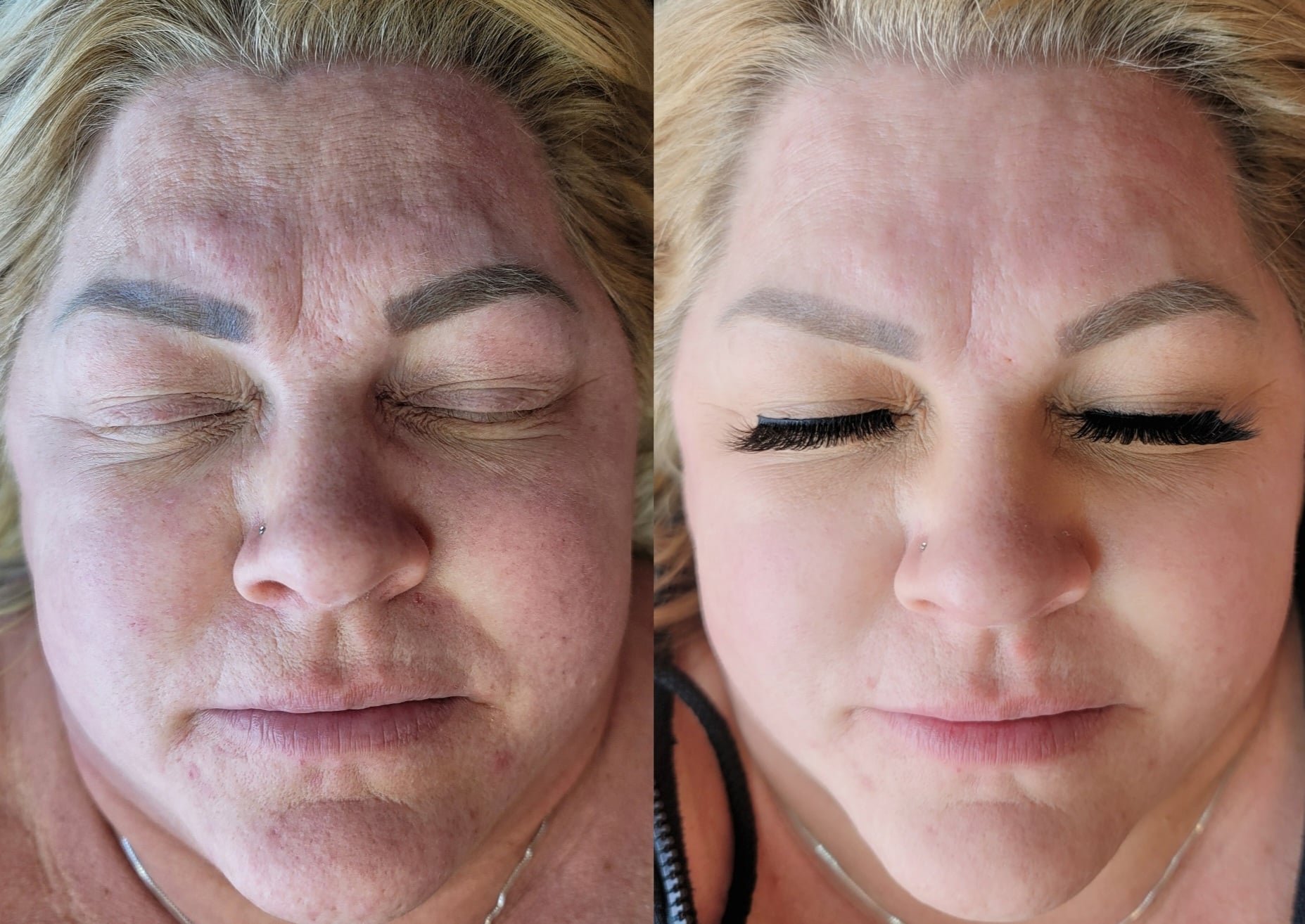 A close-up side-by-side comparison of a woman’s face before and after treatment, shown lying down with closed eyes.