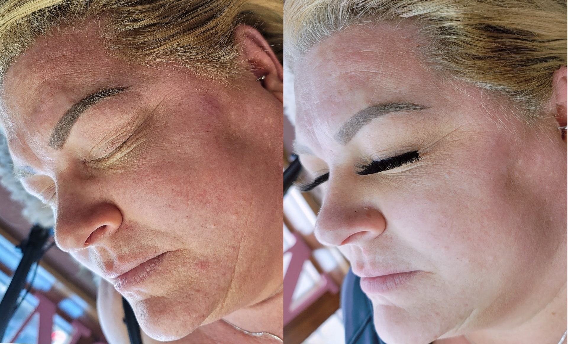 Side-by-side close-up of a woman’s face before and after cosmetic treatment, shown against a blurred indoor background.