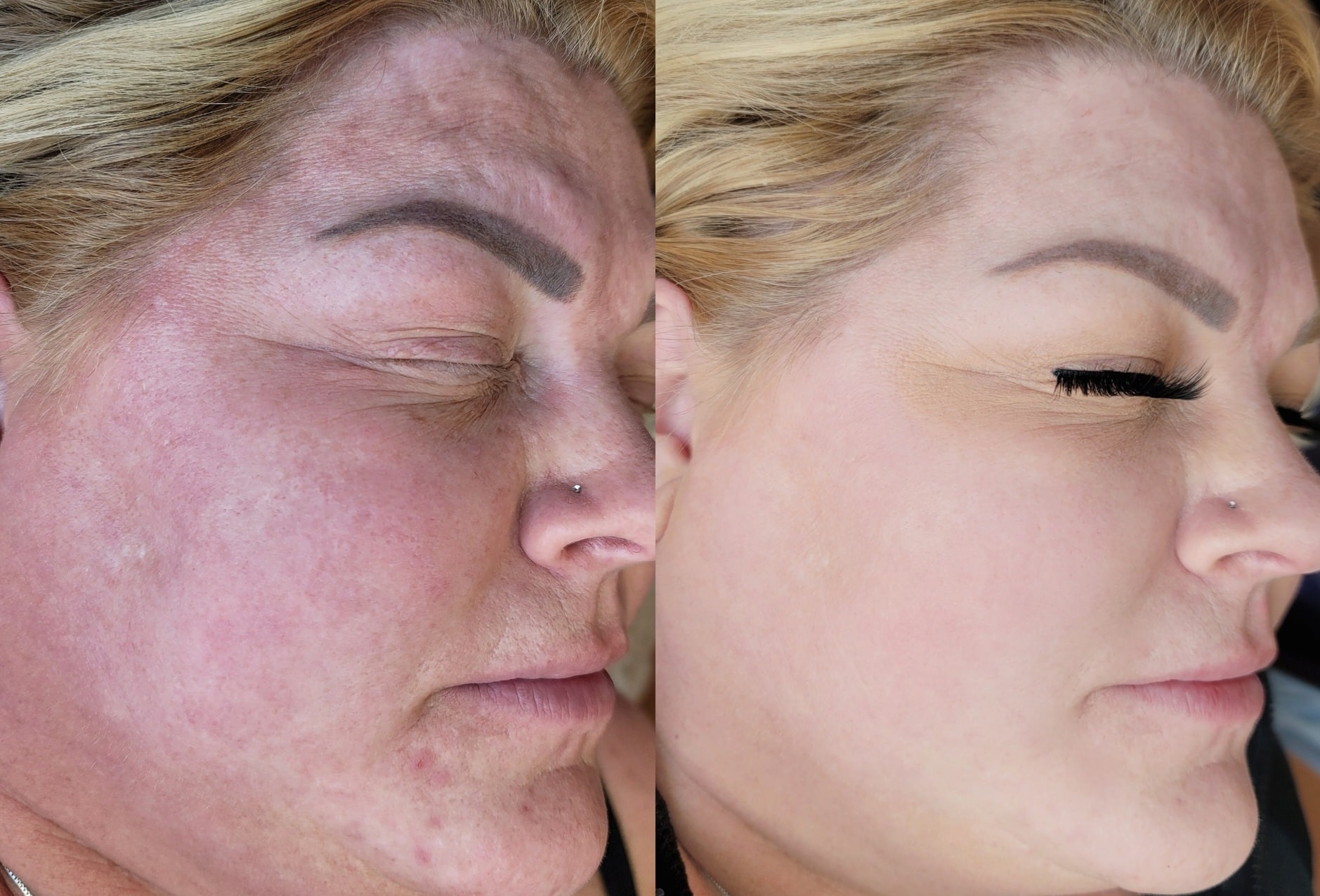 A side-by-side close-up of the same woman’s face showing before and after skin treatment, with darker pigmentation on the left and smoother skin on the right.