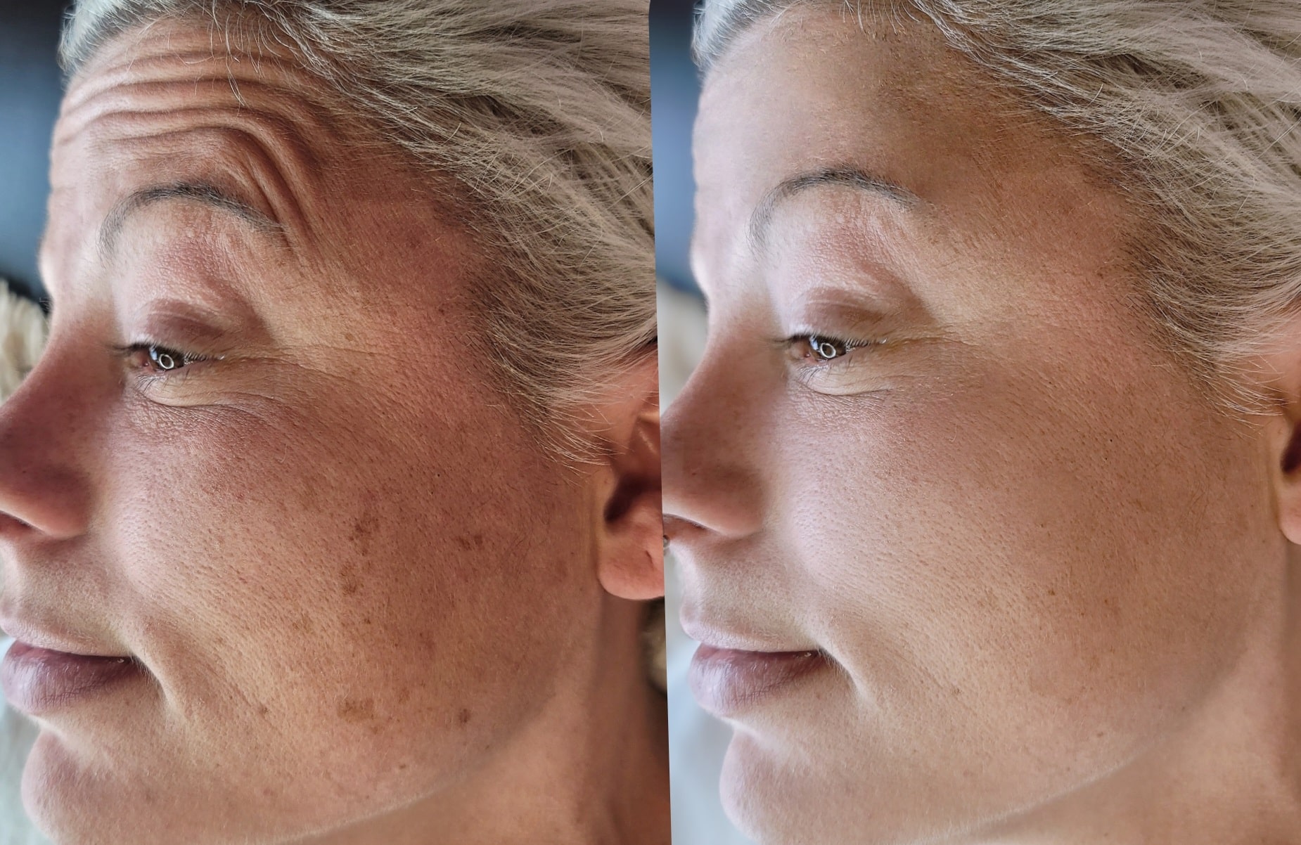 A side-by-side close-up of a woman's face showing before-and-after skin on her cheek and forehead, with a blurred blue background.