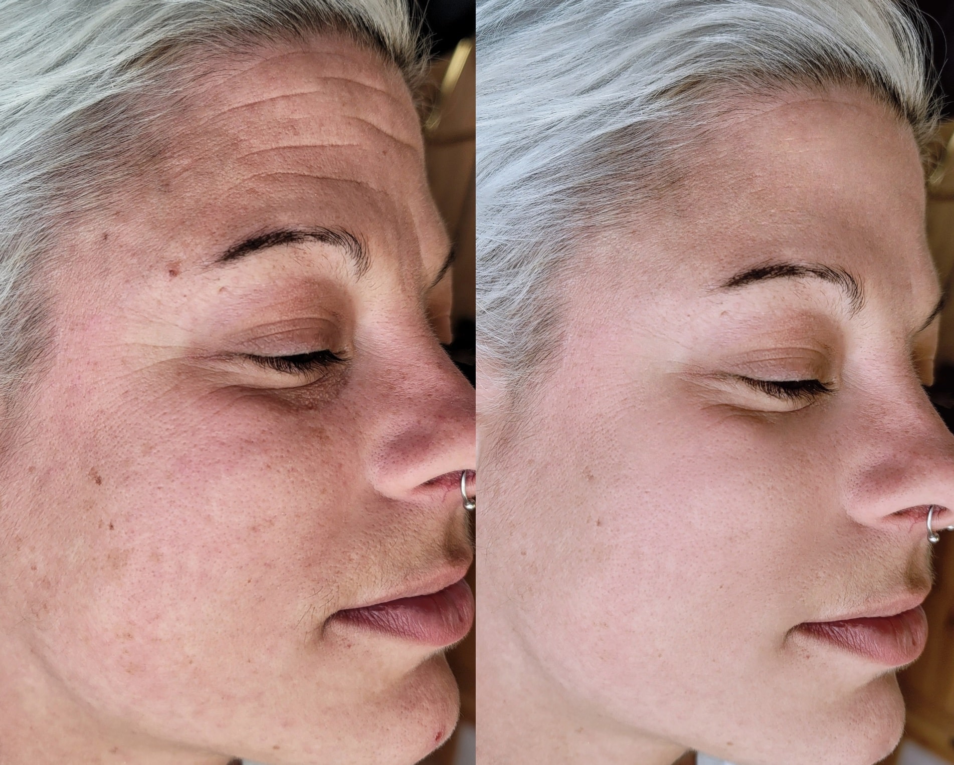 A side-by-side close-up of a woman’s face with silver hair and a nose ring, showing marked skin on the left and smoother skin on the right.