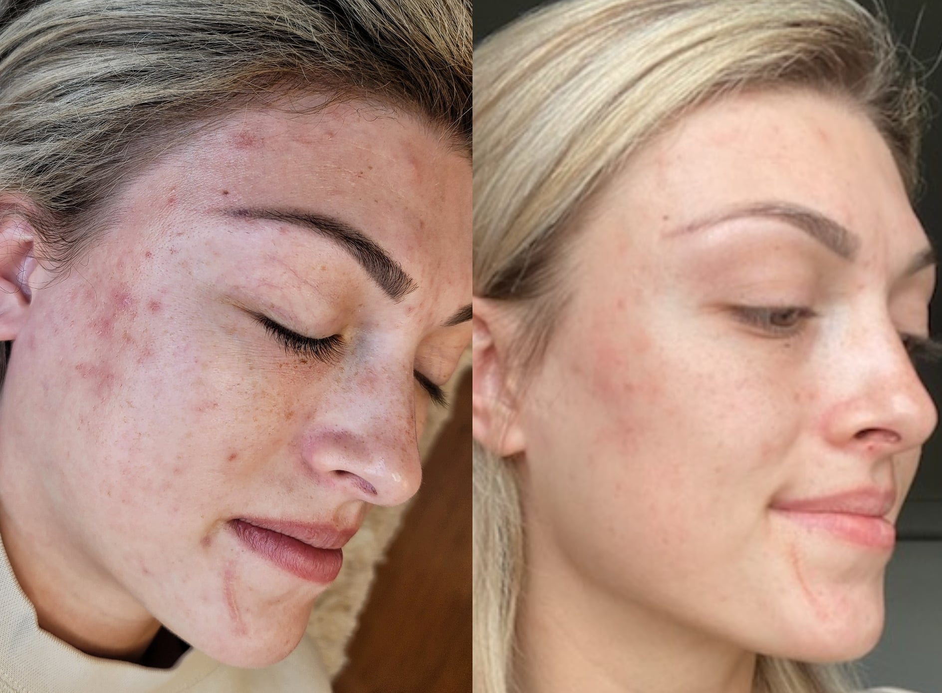 A side-by-side close-up of the same woman's face before and after skincare treatment, showing more even skin tone on the right and a neutral background.