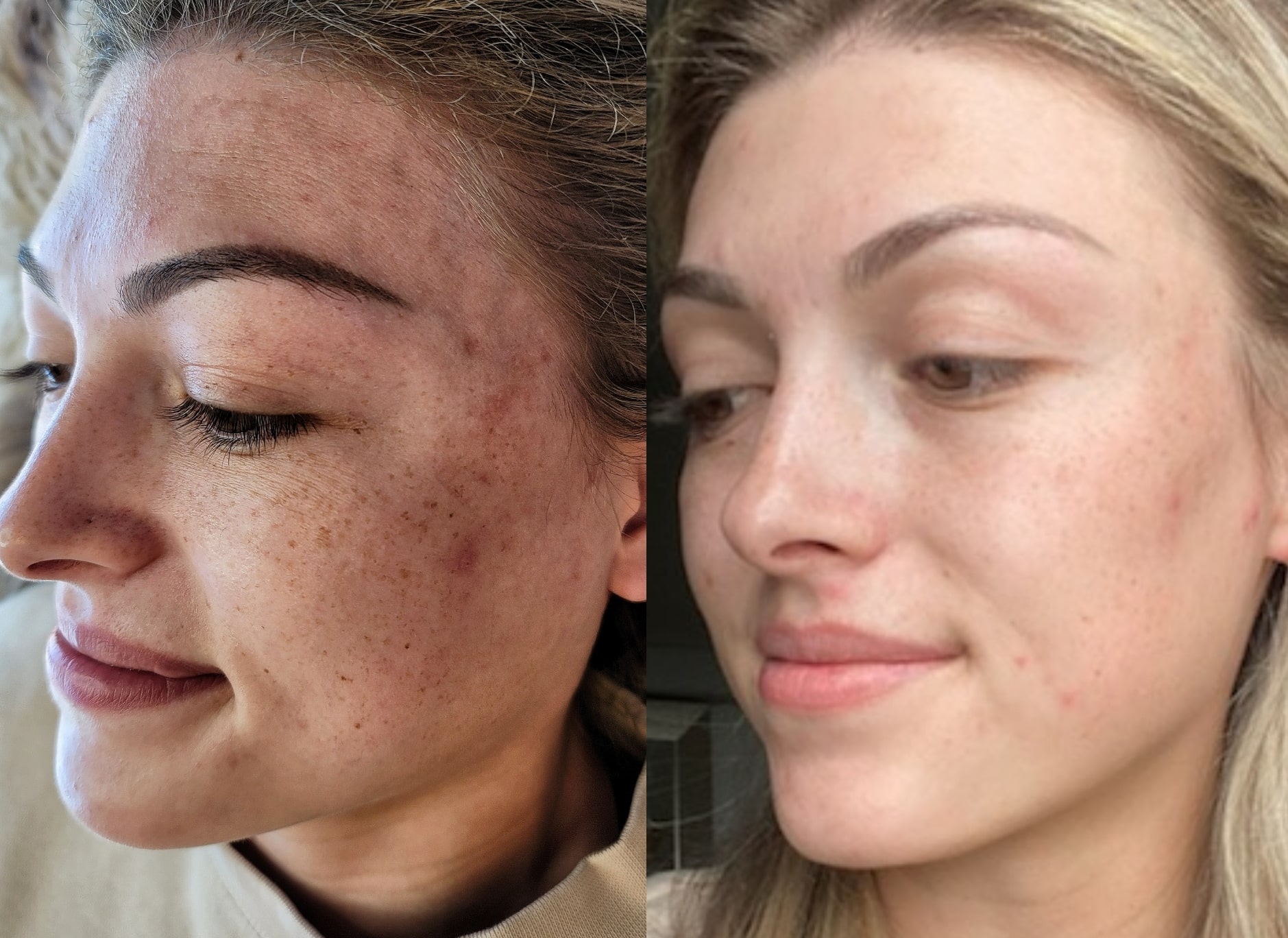 Side-by-side close-up profile photos of a woman, showing freckled skin on the left and smoother skin on the right, against indoor backgrounds.