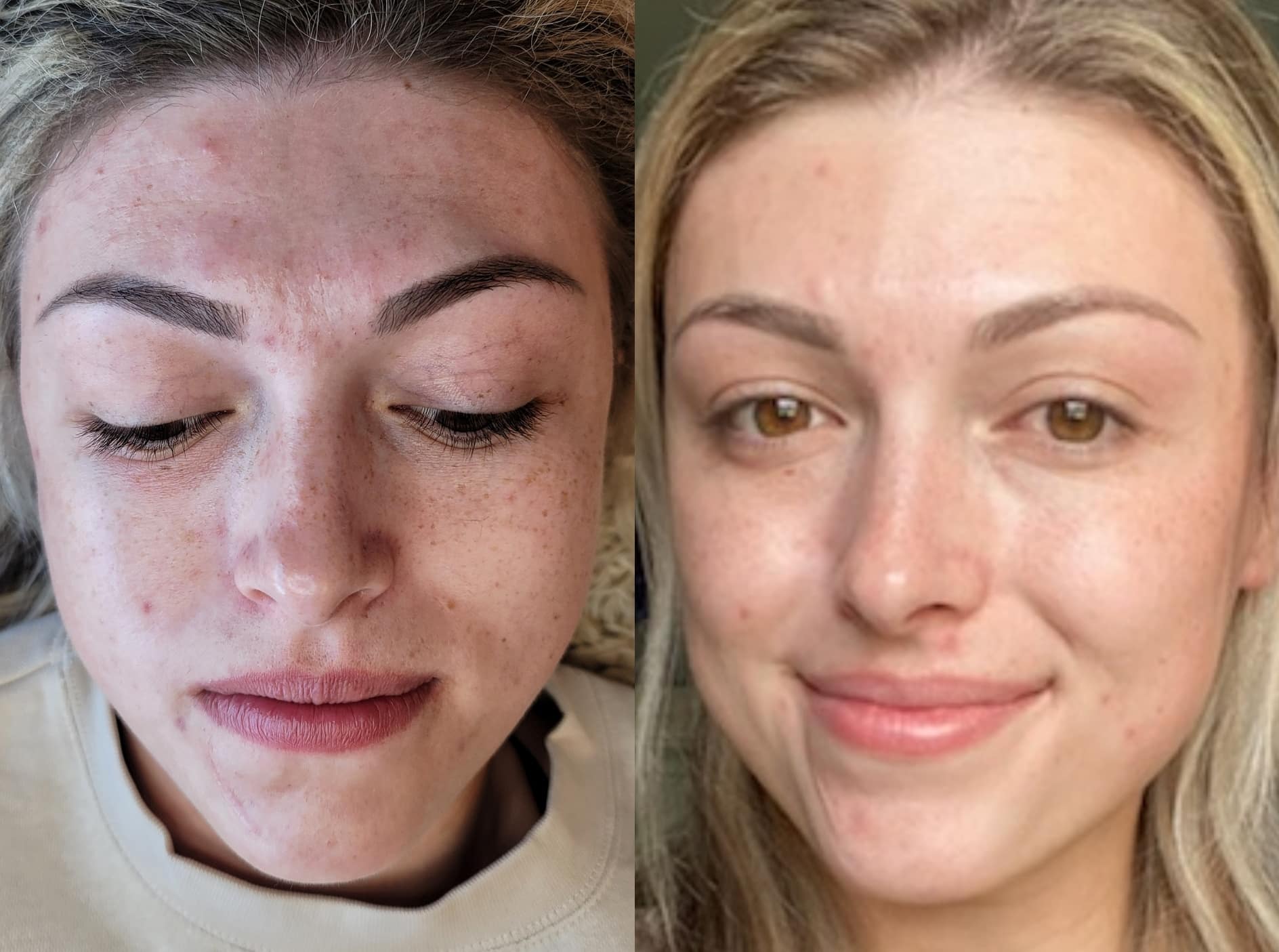 Split-screen close-up of the same woman lying down on the left and facing the camera on the right, showing freckled skin and blond hair against a neutral background.