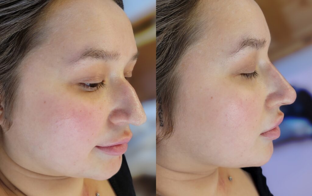 Side-by-side profile photos of a woman’s face, showing her nose and cheek from two angles against a blurred indoor background.