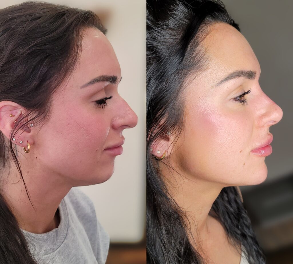 Side-by-side profile photos of the same woman before and after a cosmetic facial procedure, with her side profile shown against neutral indoor backgrounds.