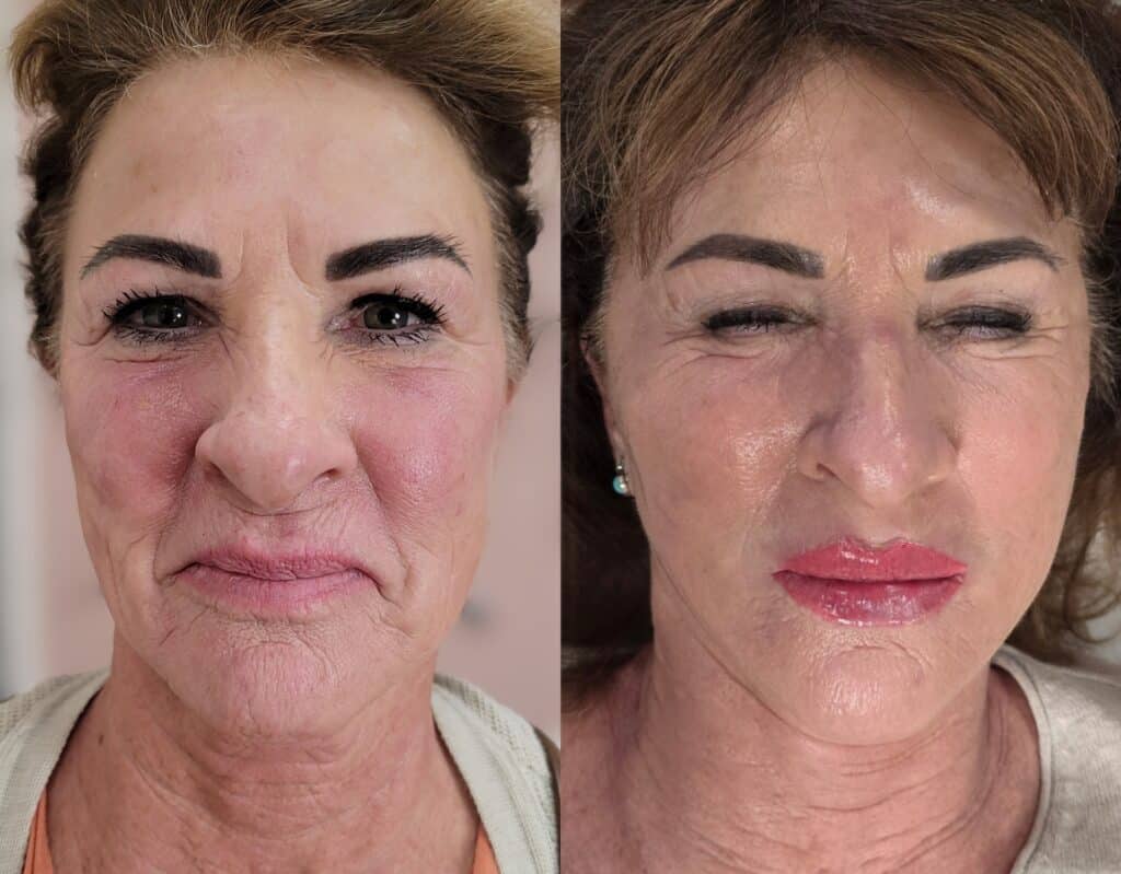 A side-by-side close-up of a woman’s face before and after treatment, with the left image showing visible wrinkles and the right image showing smoother skin against a plain background.