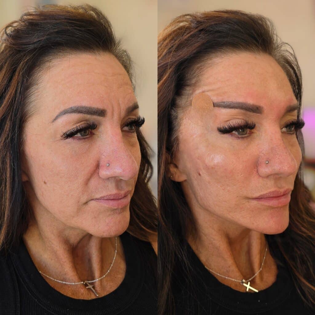 Two side-by-side close-up portraits of a woman with dark hair, her face shown before and after cosmetic treatment, against a plain indoor background.