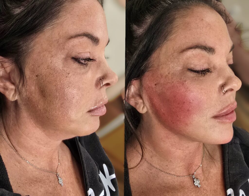 A side-by-side profile of the same woman, with the left image showing natural skin tone and the right image showing a red flush on her cheek and jaw, against an indoor background.