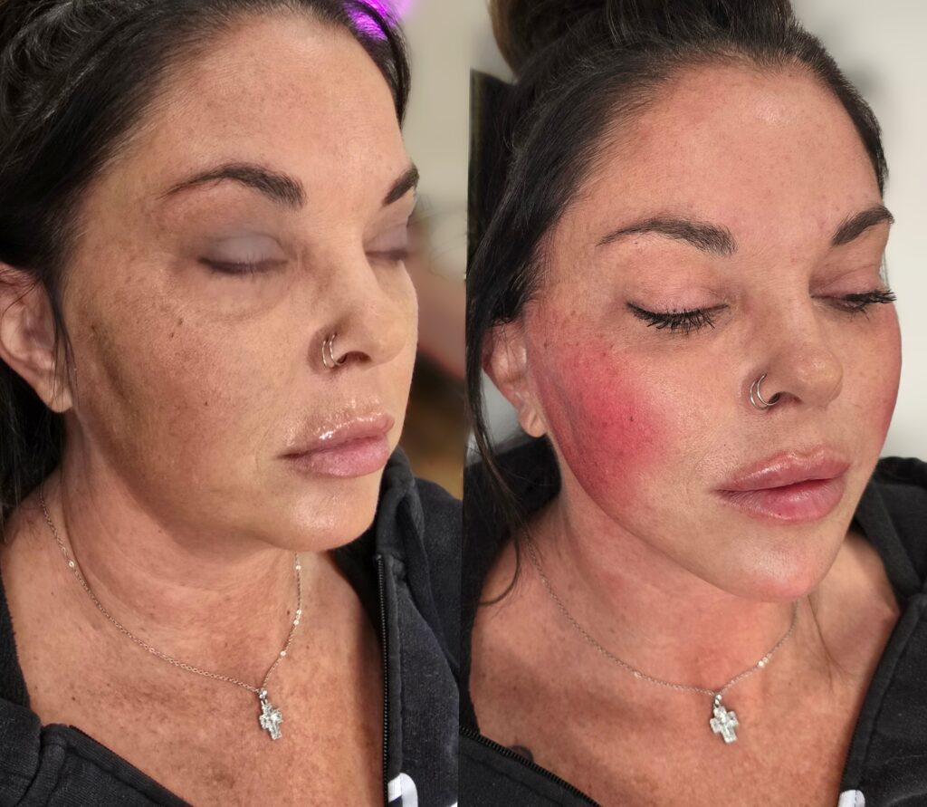 A side-by-side close-up of the same woman with her eyes closed, showing a clear-skinned face on the left and a red, flushed cheek on the right.