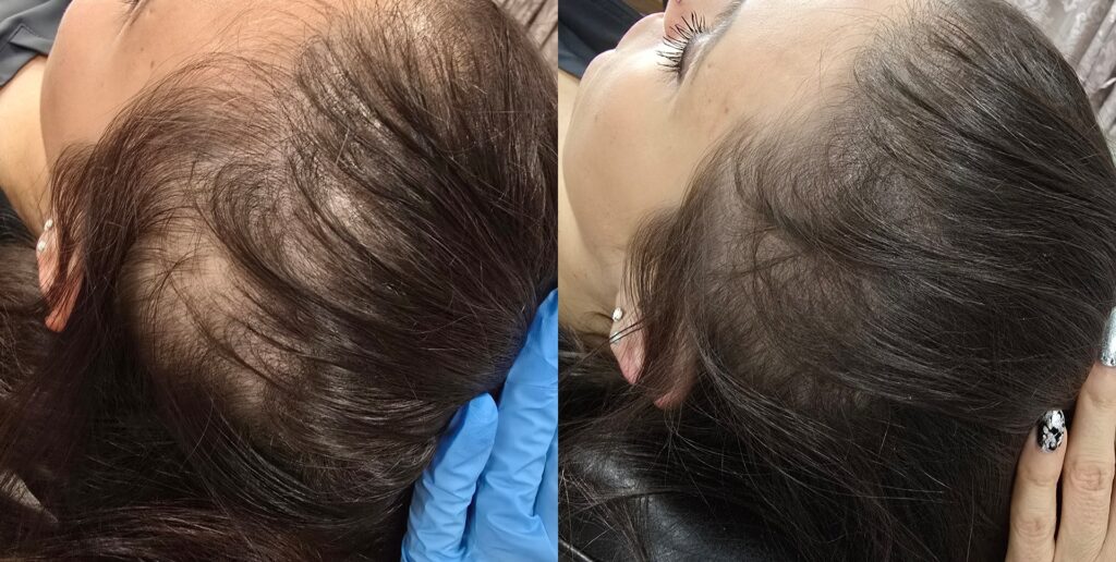 Side-by-side close-up views of a person’s scalp and thinning hairline, shown with the head tilted back and a hand resting near the ear.