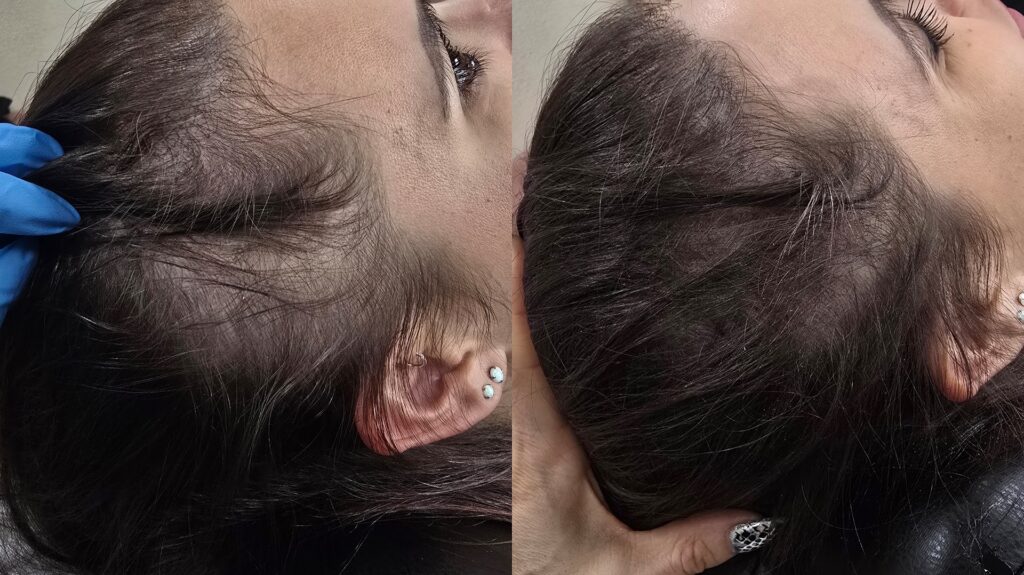 A close-up side-by-side comparison of a woman’s hairline and scalp, showing thinning hair near the temples and ear.