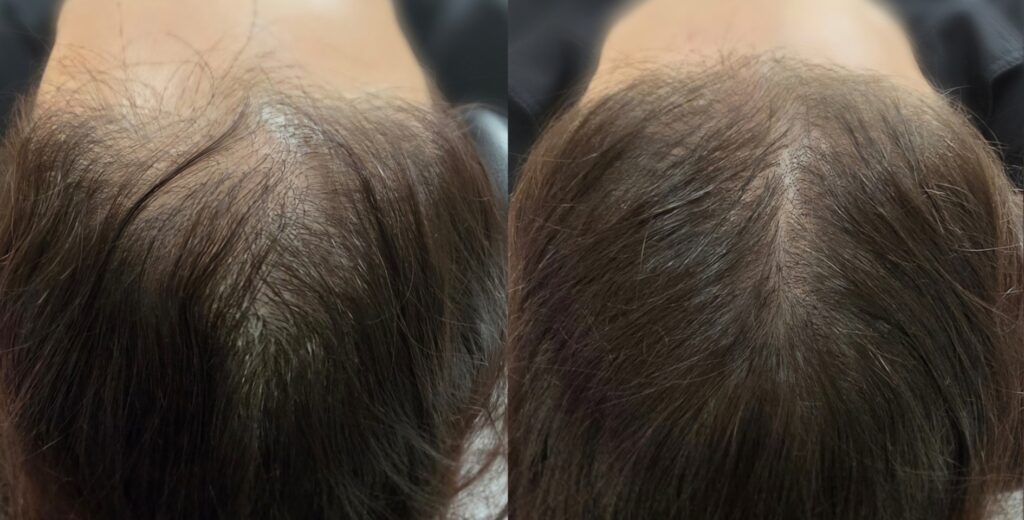 A side-by-side comparison of a balding scalp with thinning dark hair on the crown and top of the head.