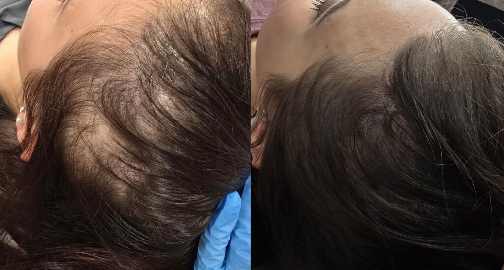 A close-up before-and-after view of a scalp showing hair thinning on top, with a gloved hand holding the head and a split-screen comparison.