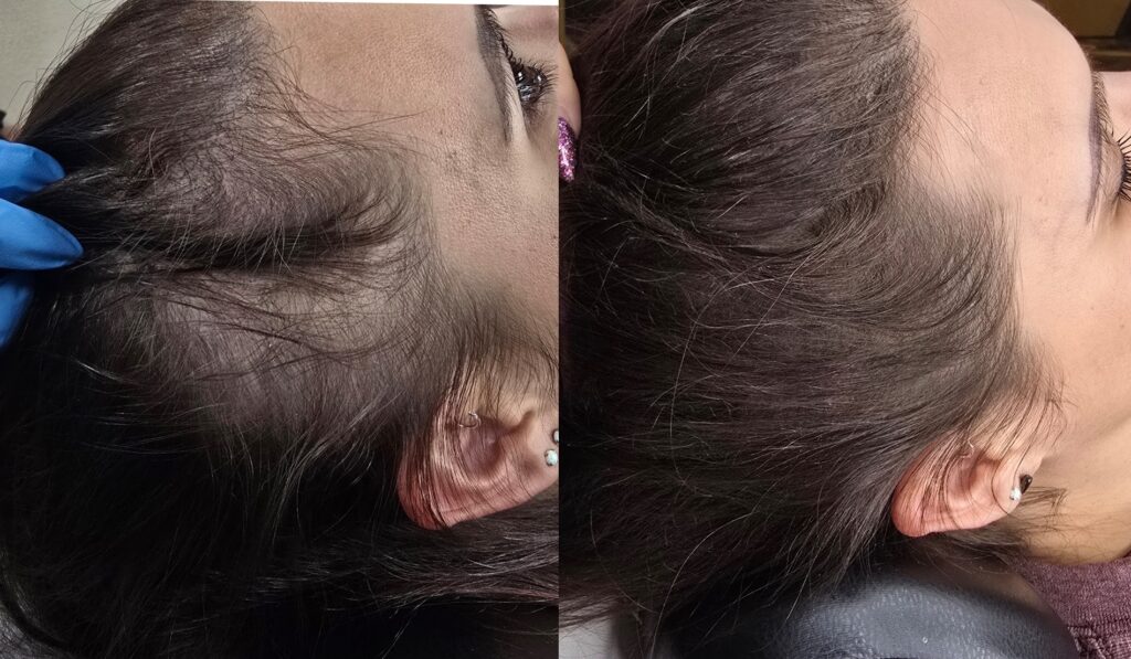 Side-by-side close-up view of a young child’s head showing hair thinning and scalp visibility near the forehead and temple.