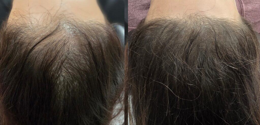 Side-by-side close-up of the top of a person's head showing thinning hair on the left and denser hair on the right.