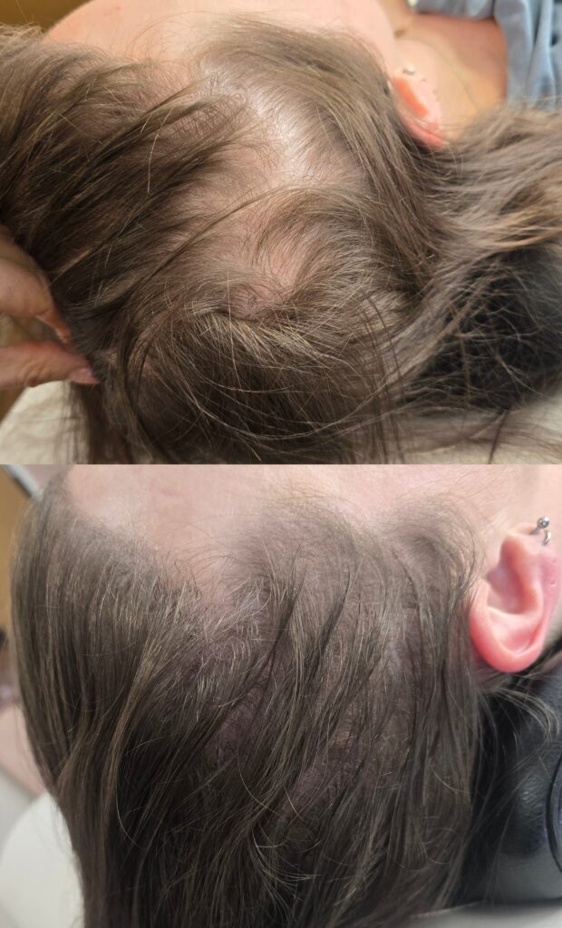 Two close-up views of a scalp with thinning hair, showing sparse hair coverage and exposed skin near the crown and side of the head.