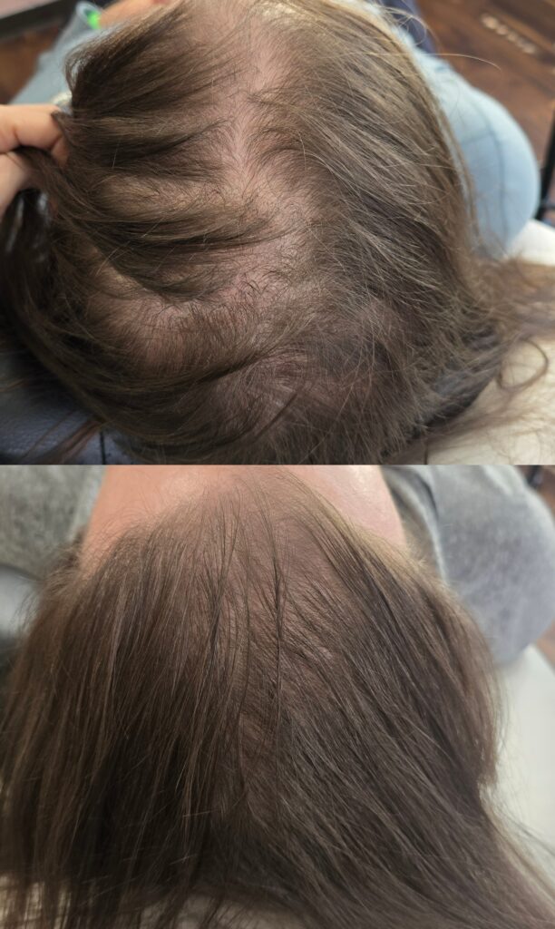 Two close-up views of the top of a person's head showing thinning hair and visible scalp, with hands and a gray shirt in the background.