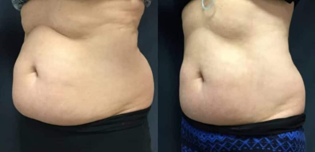 Side-by-side photos show an abdomen with visible body fat, above dark clothing and against a dark background.