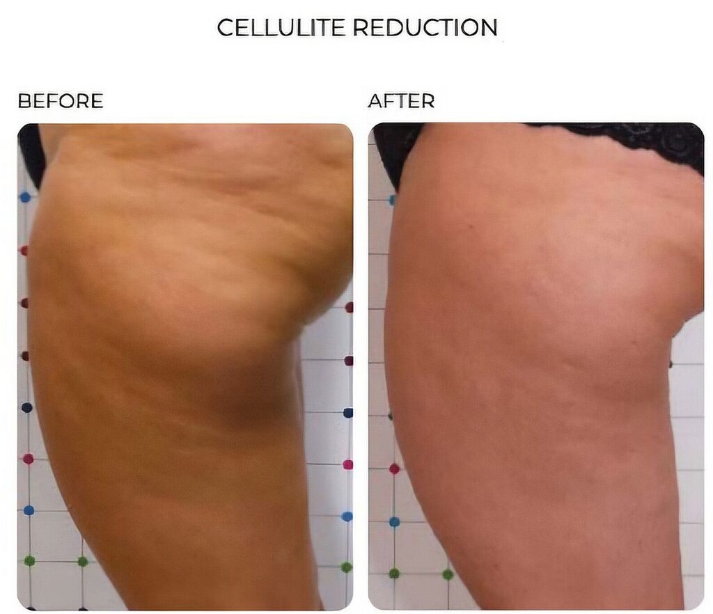 Side-by-side before-and-after images show a thigh with reduced cellulite against a measurement grid background.