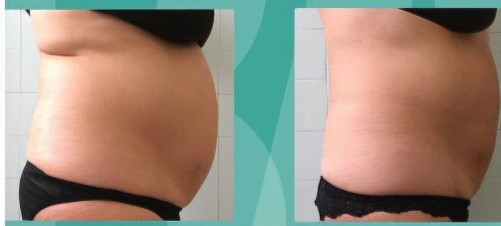 A side-by-side comparison shows a bare abdomen in black underwear, with a larger belly on the left and a flatter waist on the right against a tiled background.