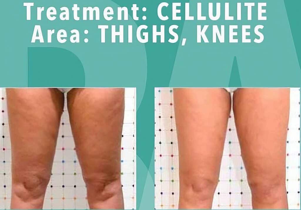 A before-and-after comparison of legs from thighs to knees, labeled cellulite treatment area, shown against a measurement grid.