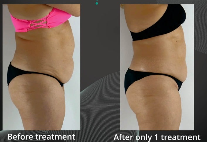 Side-by-side before-and-after photos of a woman's torso and hips in black underwear, with the left image labeled before treatment and the right image labeled after only 1 treatment.