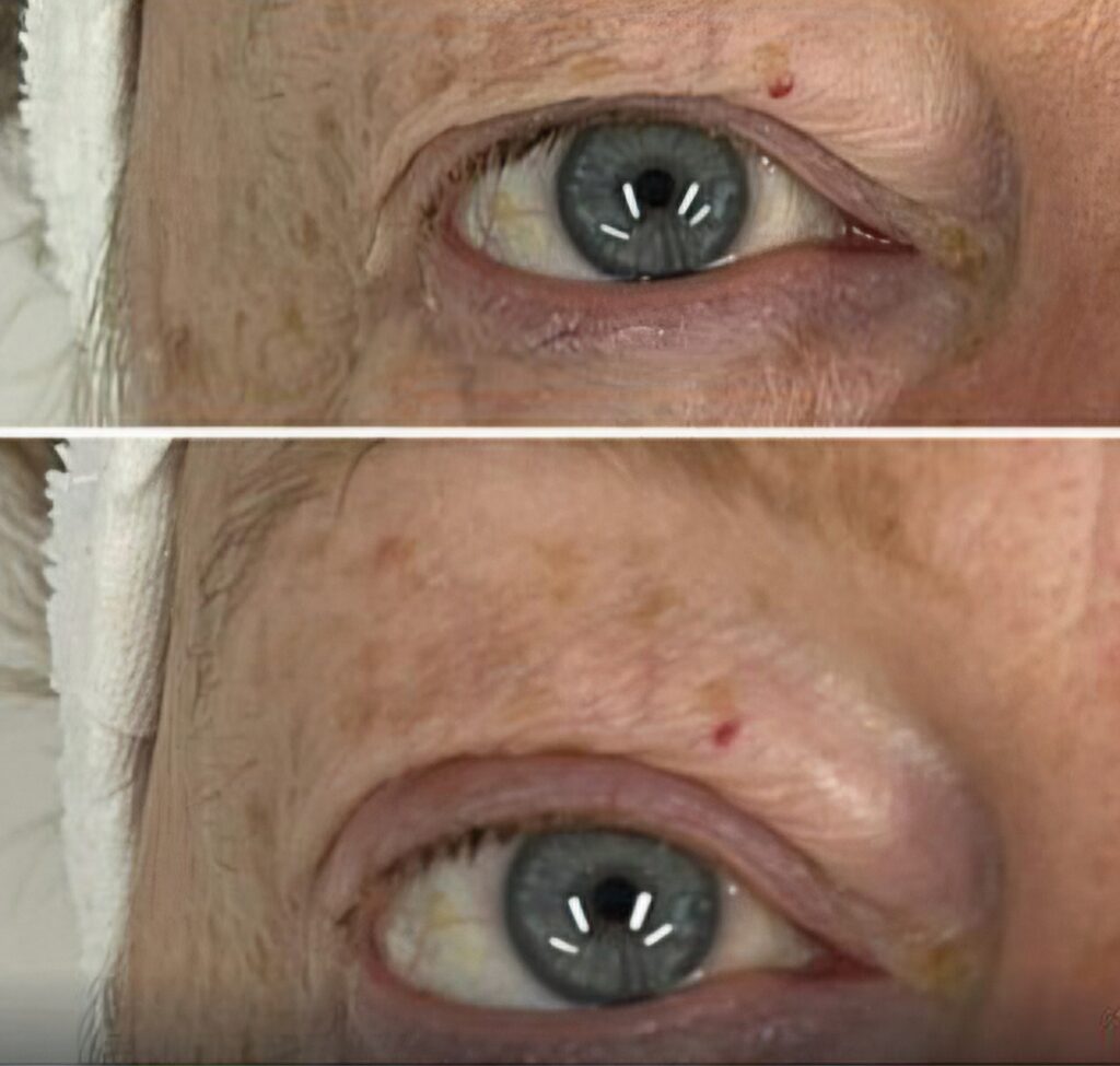Two close-up views of an older person’s eye and upper cheek, showing wrinkles and a small red mark on the skin.
