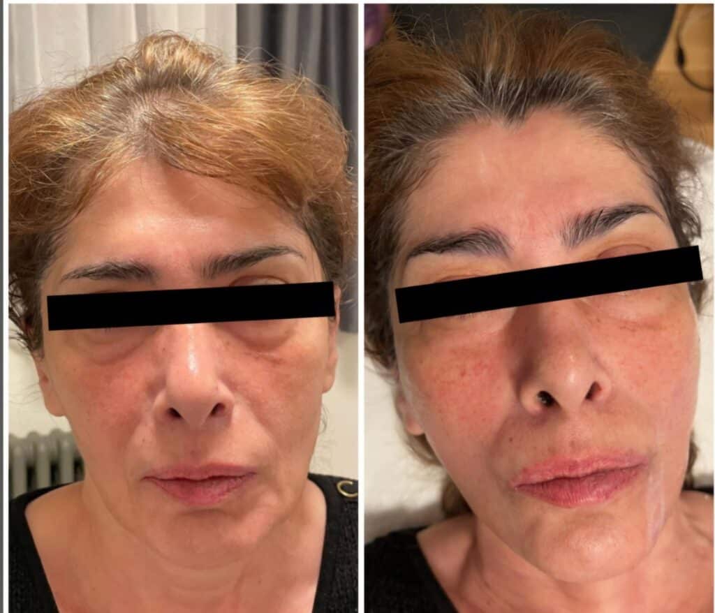 Side-by-side close-up photos of the same woman before and after treatment, with a black bar covering her eyes in both images.
