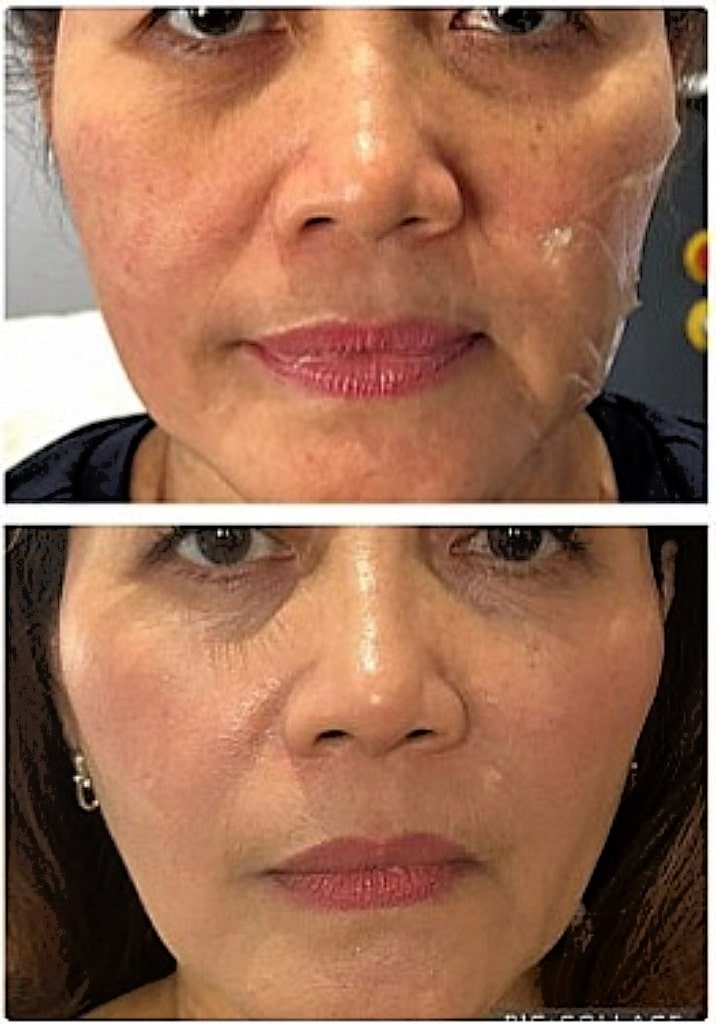 A close-up before-and-after comparison of a woman's face, showing a visibly smoother complexion in the lower image.