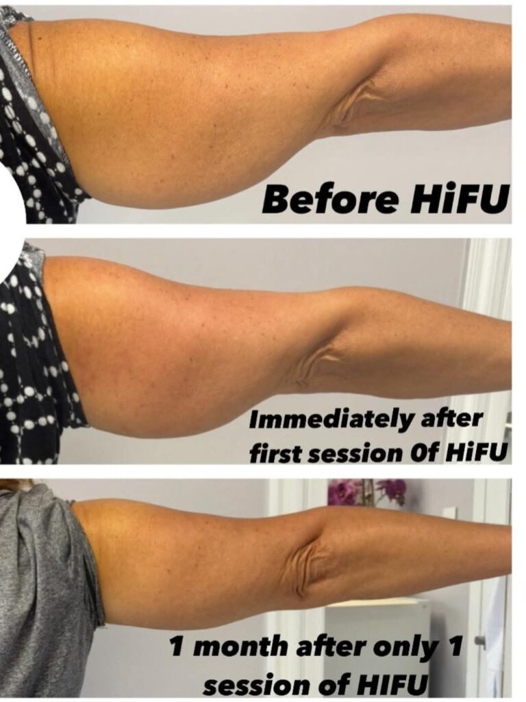 Three side-by-side profile views of an upper arm labeled before HIFU, immediately after the first session, and one month after one session, shown against a plain background.