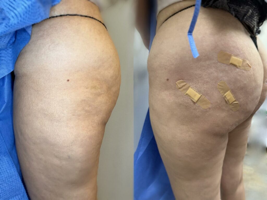 Side-by-side view of a person’s buttocks, with the right side showing several adhesive bandages and a blue surgical drape in the background.