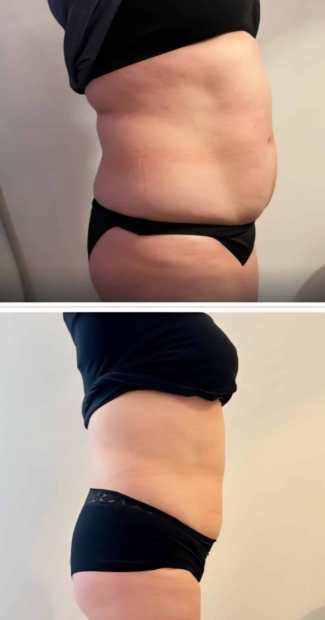 Two side-profile photos show the same person’s midsection in black underwear against a plain light wall, with a slimmer waist in the lower image.