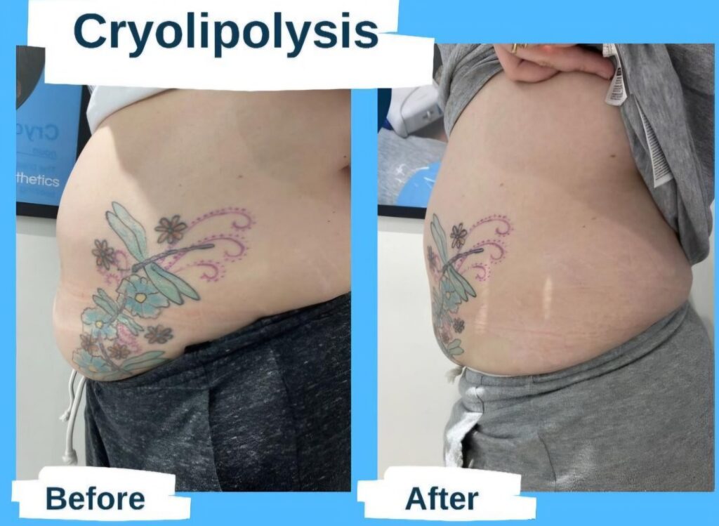 Before-and-after comparison of a tattooed side abdomen labeled cryolipolysis, with a larger belly on the left and a slimmer waist on the right.
