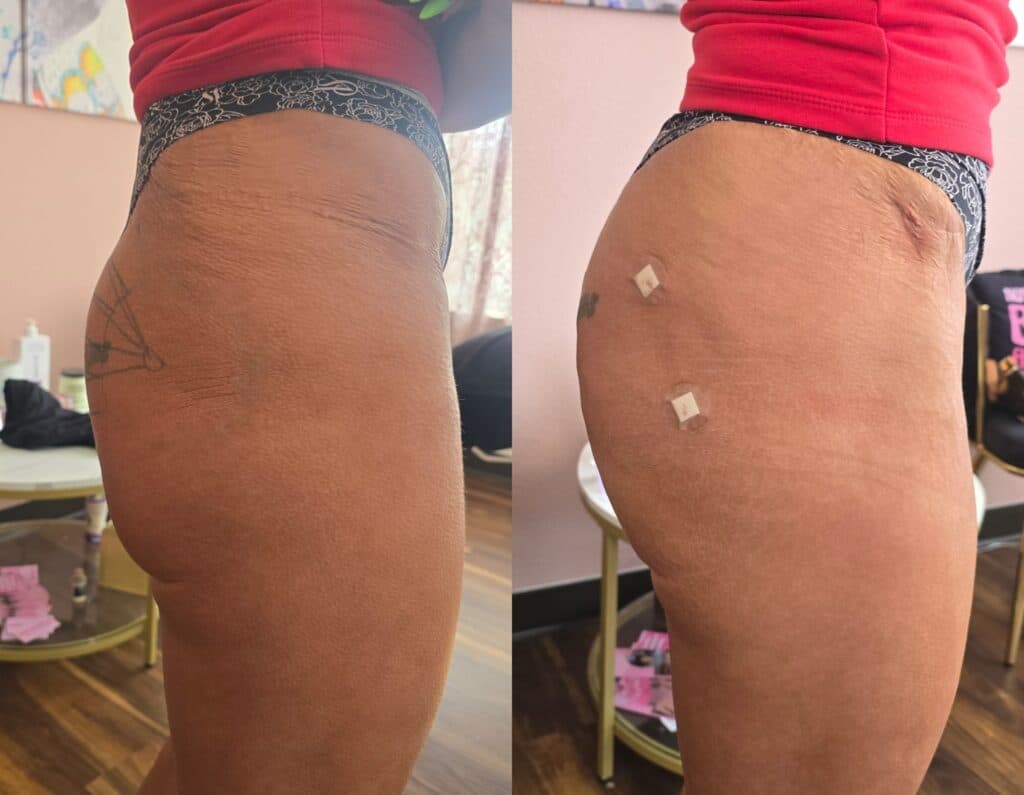 Side-by-side close-up of a person's hip and thigh, showing skin with a tattoo on the left image and two small adhesive bandages on the right, in a room with a chair and wooden floor.