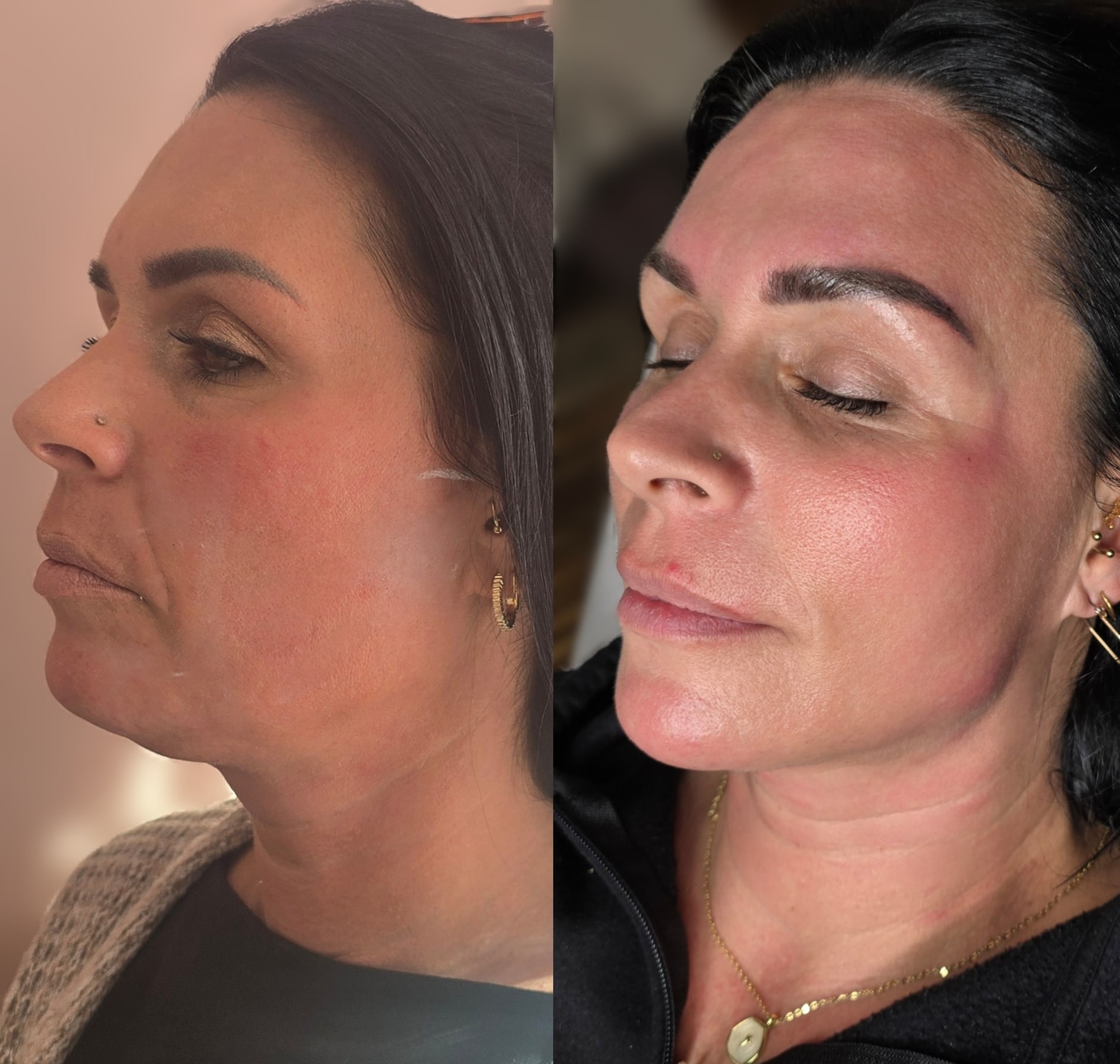 Side-by-side profile photos of a woman with dark hair, showing her face before and after a cosmetic treatment against plain indoor backgrounds.