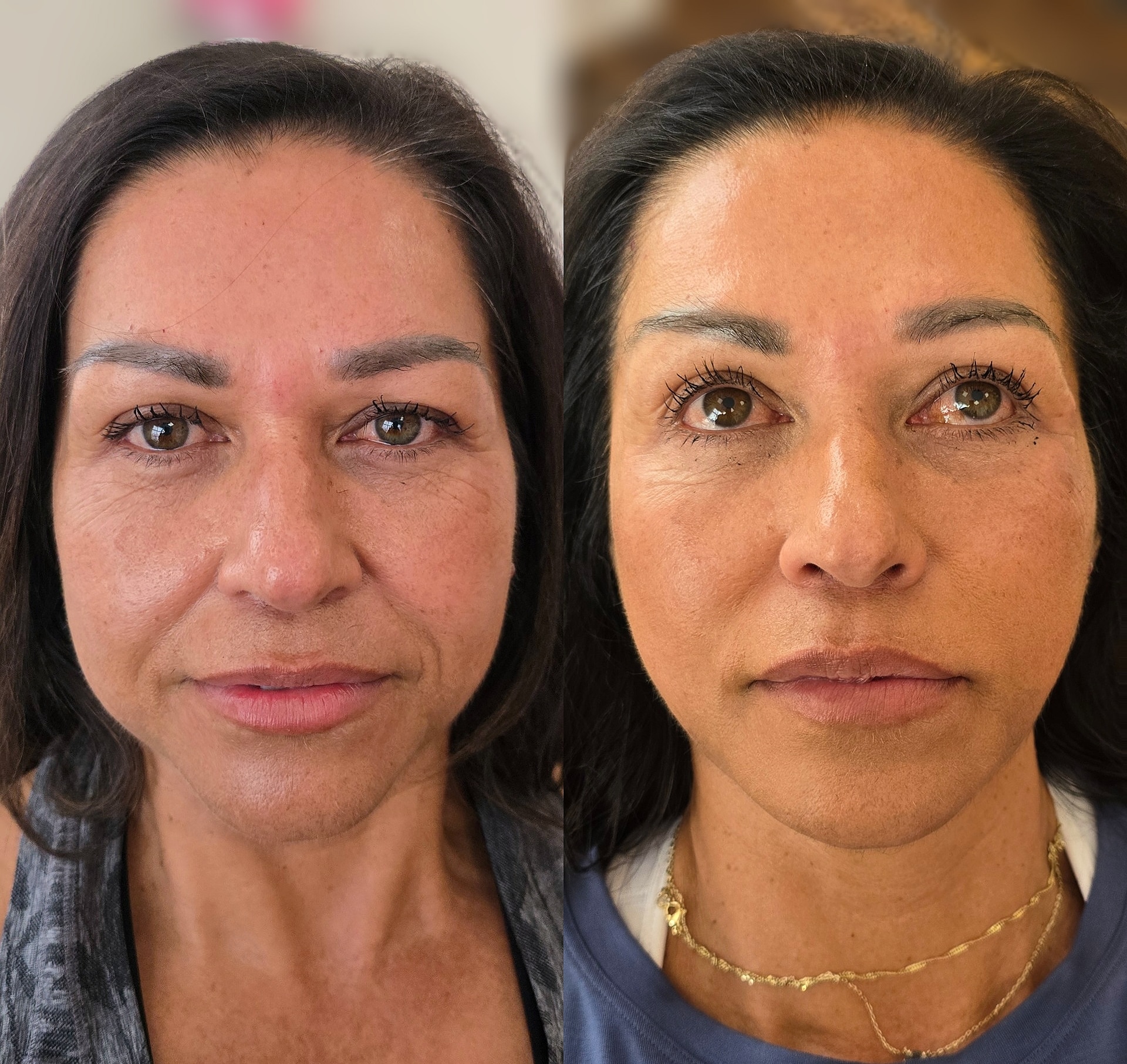 A split-screen portrait shows the same woman before and after treatment, with more even skin tone, followed by a plain indoor background.