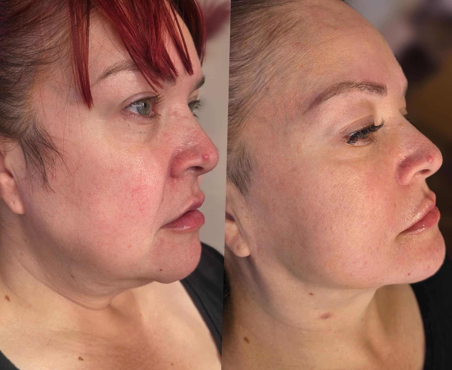 Side-by-side profile portraits of the same woman before and after, showing a smoother face and neckline against a plain background.